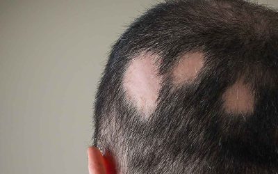 Alopecia Areata (Pletskaldethed)