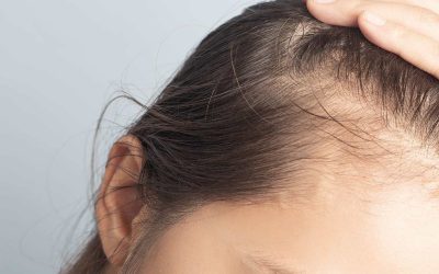 Traction Alopeci (Overbelastning af håret)