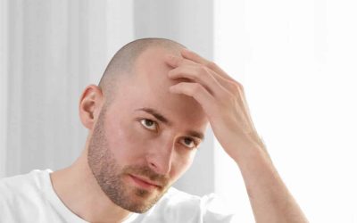 Skaldethed / Androgen Alopeci