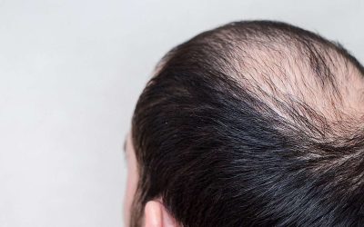 De vanligaste orsakerna till håravfall