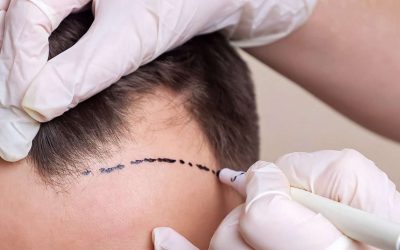 Alternativ för håravfall