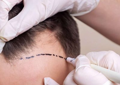 Alternativ för håravfall