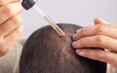 Medicinsk behandling av håravfall