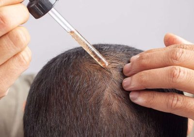 Medicinsk behandling av håravfall