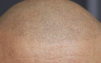 10 skäl att välja skalppigmentering (SMP)