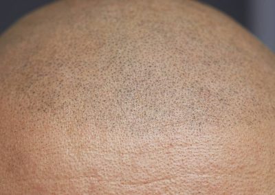 10 skäl att välja skalppigmentering (SMP)