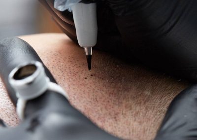 Tekniken bakom mikropigmentering av hårbotten