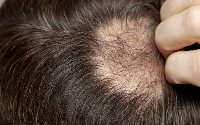 Alopecia