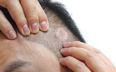 Scarring Alopecia