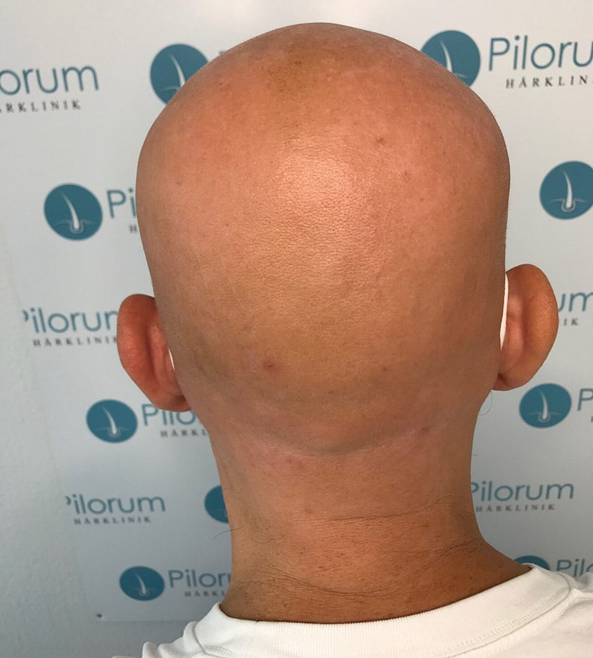 Alopecia-universalis_totalis-scaled-e159505034139