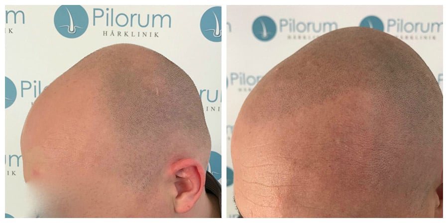 Mikropigmentering av hårbotten (SMP)