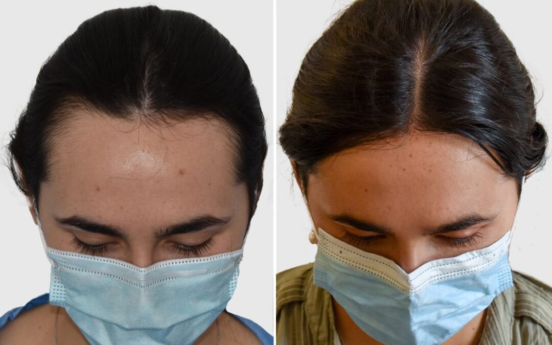 Hårtransplantation före och efter