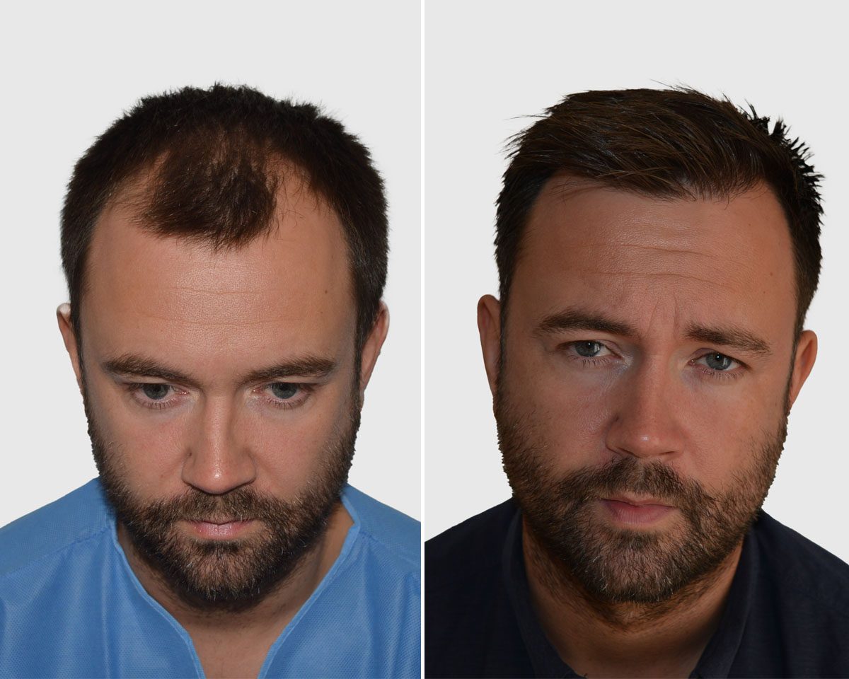 Hårtransplantation före och efter