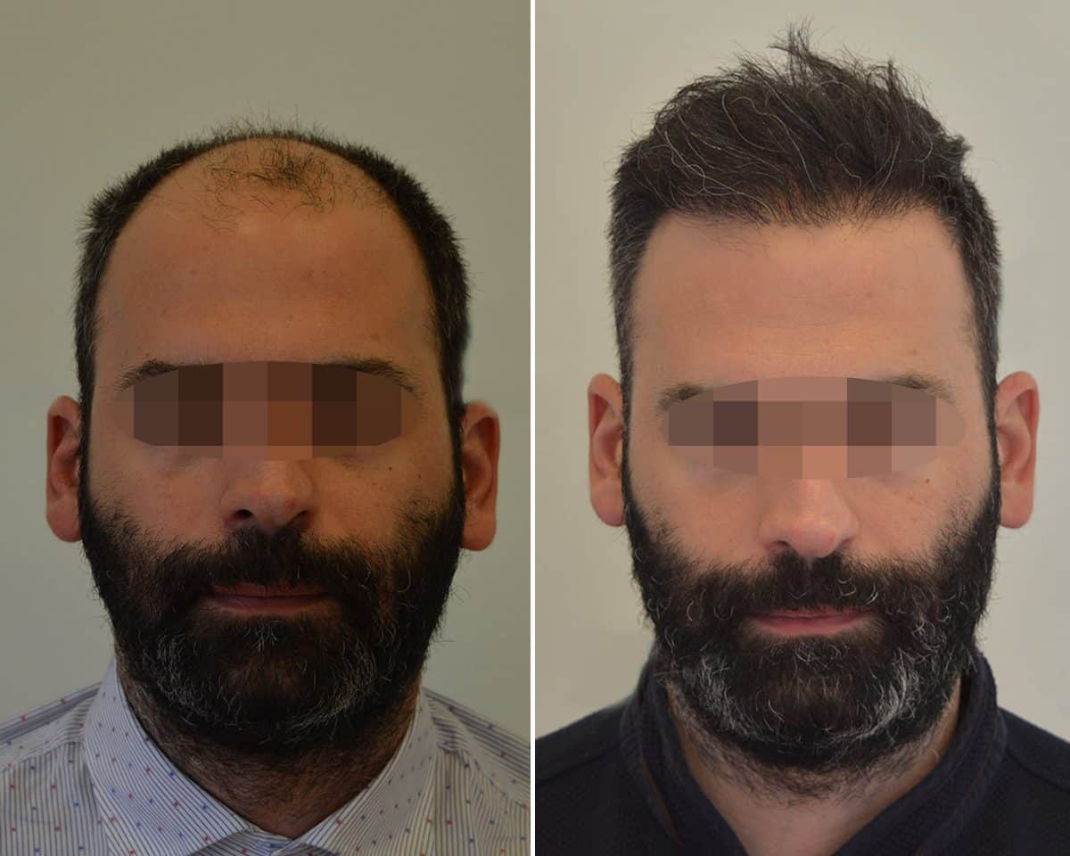 Hårtransplantation före och efter