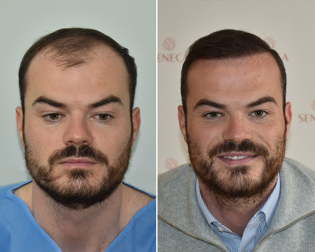 Hårtransplantation före och efter