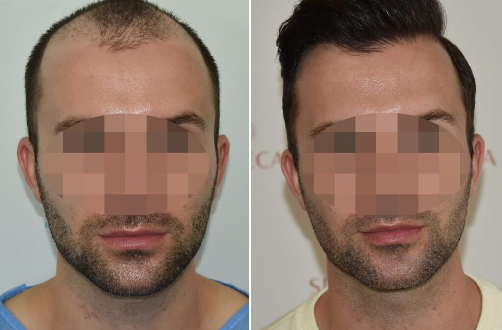 Hårtransplantation före och efter