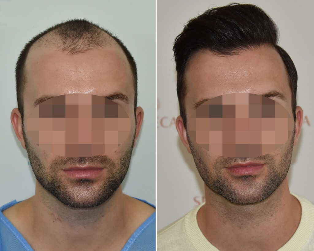 Hårtransplantation före och efter