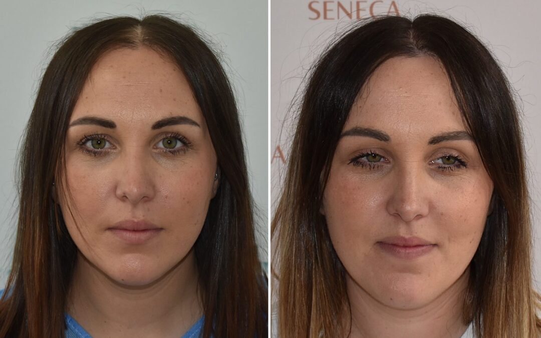 Hårtransplantation före och efter