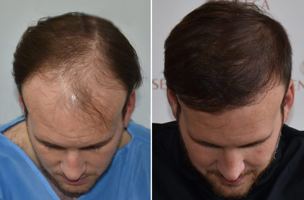 Hårtransplantation före och efter