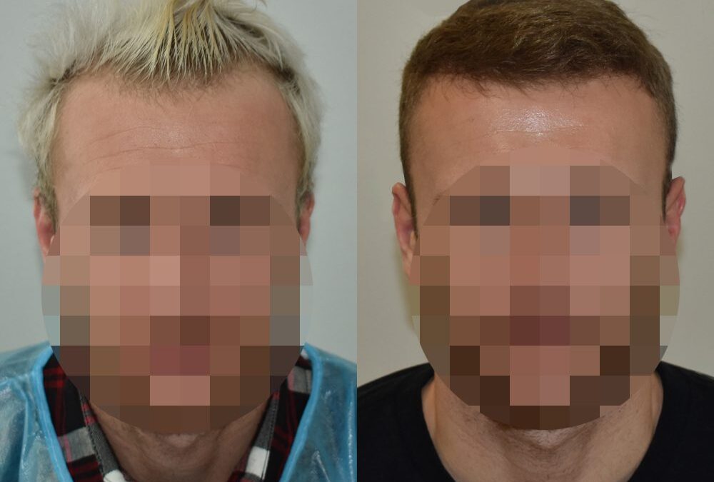 Hårtransplantation före och efter