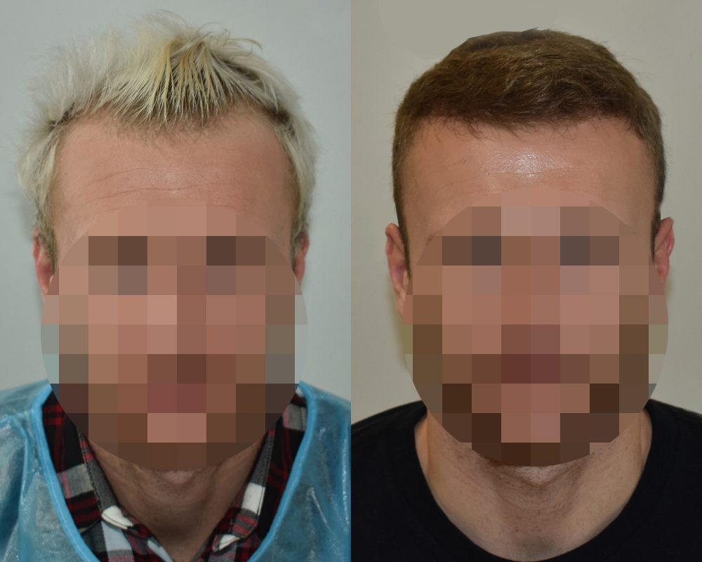 Hårtransplantation före och efter