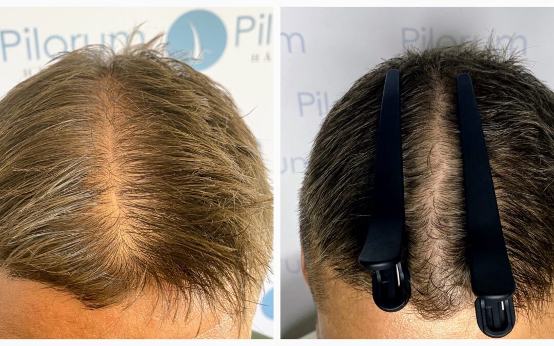 V2X-behandling + extrakt